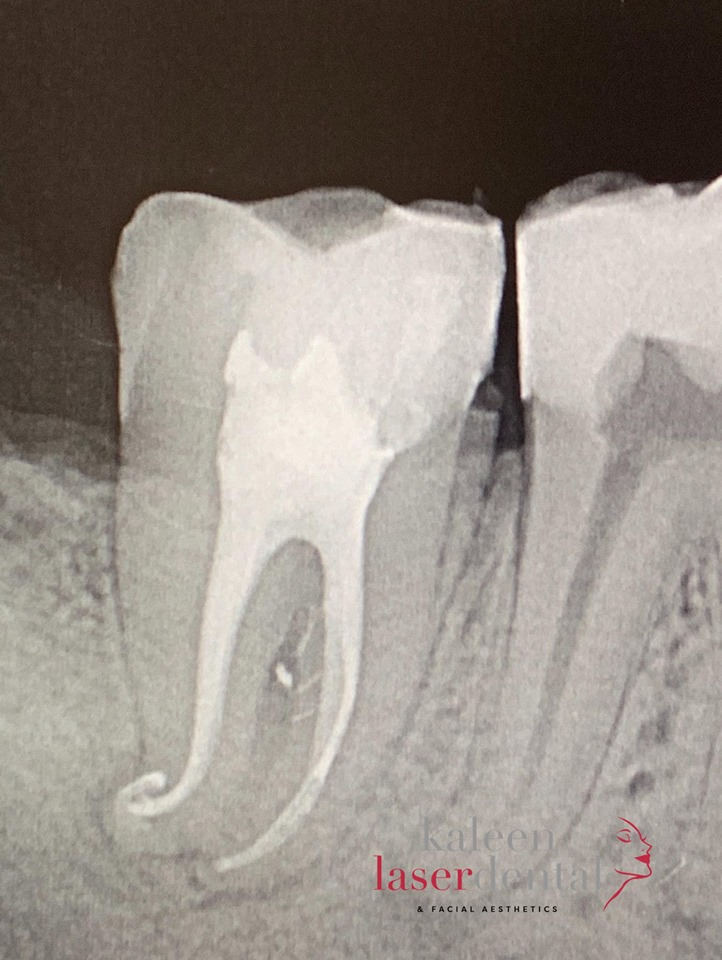 Sweeps — Curved Canal Case